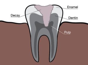 Sensitive tooth scheme