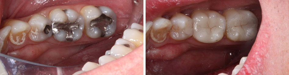 Before and after of same-day crowns in Edwards, CO. 