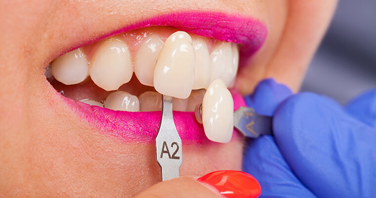 A close-up of veneers being color-matched to original teeth